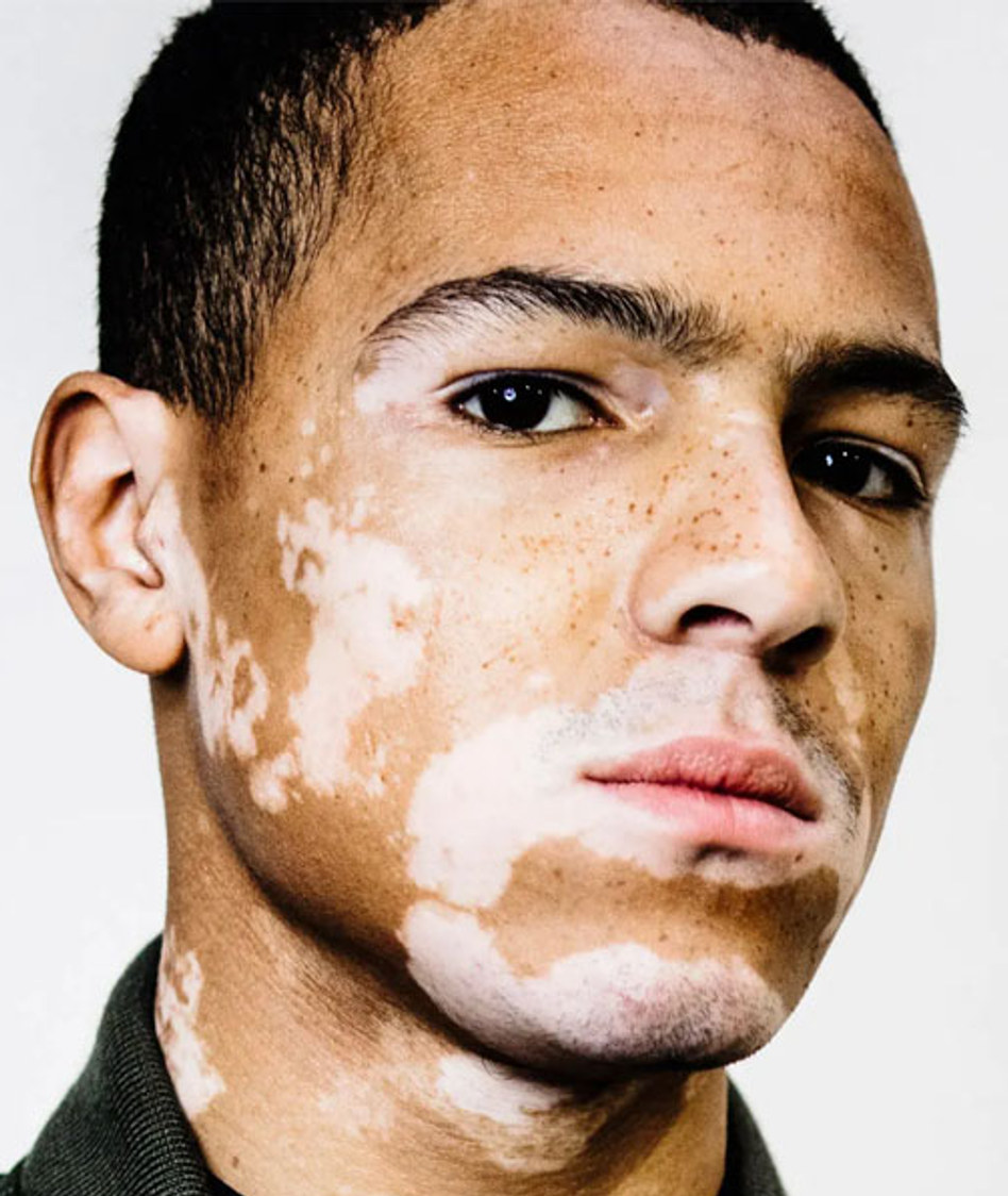 Retrato con vitiligo